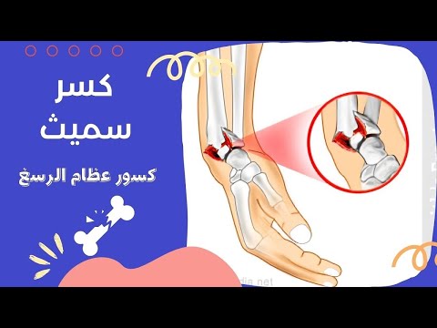 كسر سمث (كسر عظم الكعبرة والرسغ )