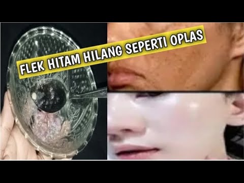 Nyesel Baru Coba Sekarang!! Menghilang Semua Jenis Flek Hitam yang Ada Tanpa Bekas