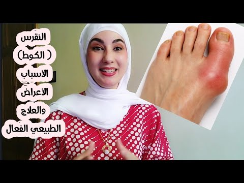 النقرس:  علاش كيوقع وشنو الحل ؟