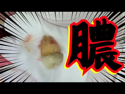 移植した歯が崩壊！大量の膿を歯医者で治療！