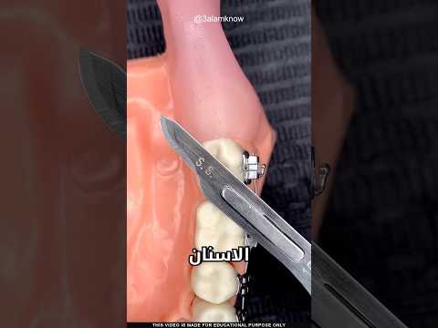 لماذا يخلع السن بهذه الطريقة