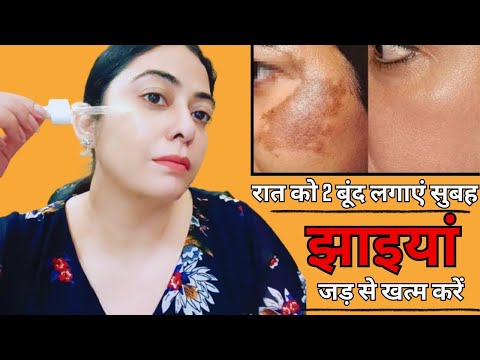 कितनी भी पुरानी झाइयां, काले दाग-धब्बें जड़ से खत्म करो || How to Remove Pigmentation Permanently