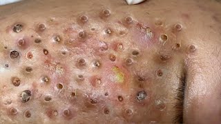 Loan Nguyen Acne Treatment 122