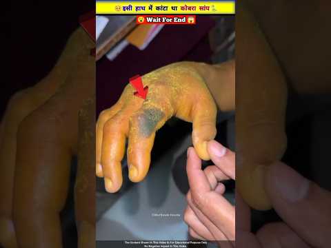 इसी हाथ में काटा था कोबरा सांप 😱🐍
