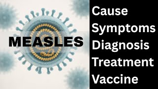 Measles: Causes, Symptoms, Diagnosis, Treatment, Vaccine, and Recent Outbreak