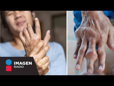 ¿Qué es y qué causa la artritis reumatoide? | Bien y Saludable