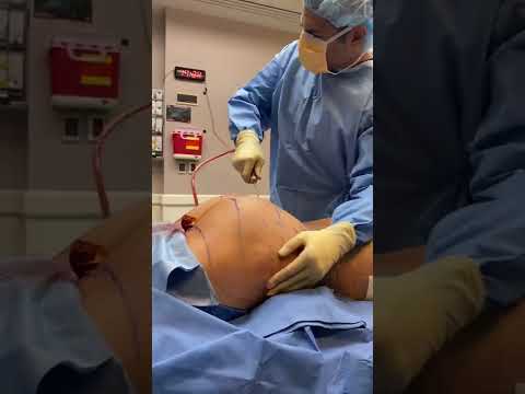Transgender Breast Augmentation AND BBL ALL IN ONE