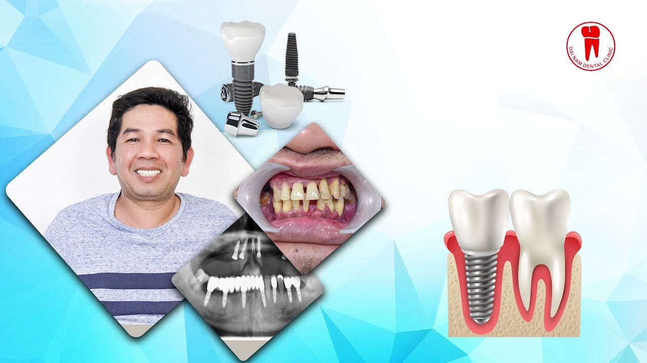 Diễn viên Lý Hùng chia sẻ quá trình làm răng sứ tại Nha khoa Đại Nam