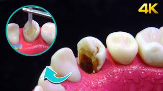 ASOMBROSA restauración de diente con caries: Corona en 4K