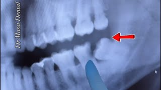 WISDOM TEETH CAN GROW INTO THE ADJACENT SECOND MOLAR TEETH AND CAUSE CAVITIES
