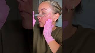 How to Microneedle at Home