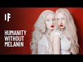 Understanding Albinism and Its Challenges