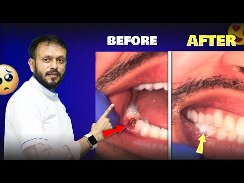 Implants with fix teeth just in 5 Days ! Best dental implant surgeon In Mumbai