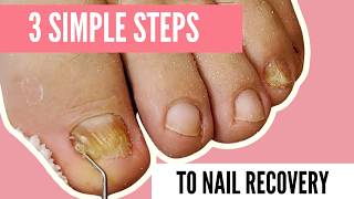 How to: At Home Toenail Care for Fungus with Athlete's Foot