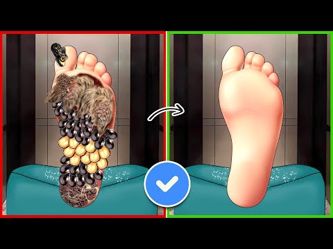 ASMR Removal Dog Ticks, Giant Maggot Infected From Foot | Severely Injured Treatment Animation