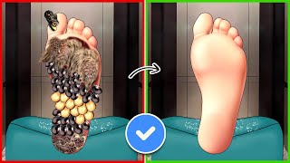 ASMR Removal Dog Ticks, Giant Maggot Infected From Foot | Severely Injured Treatment Animation