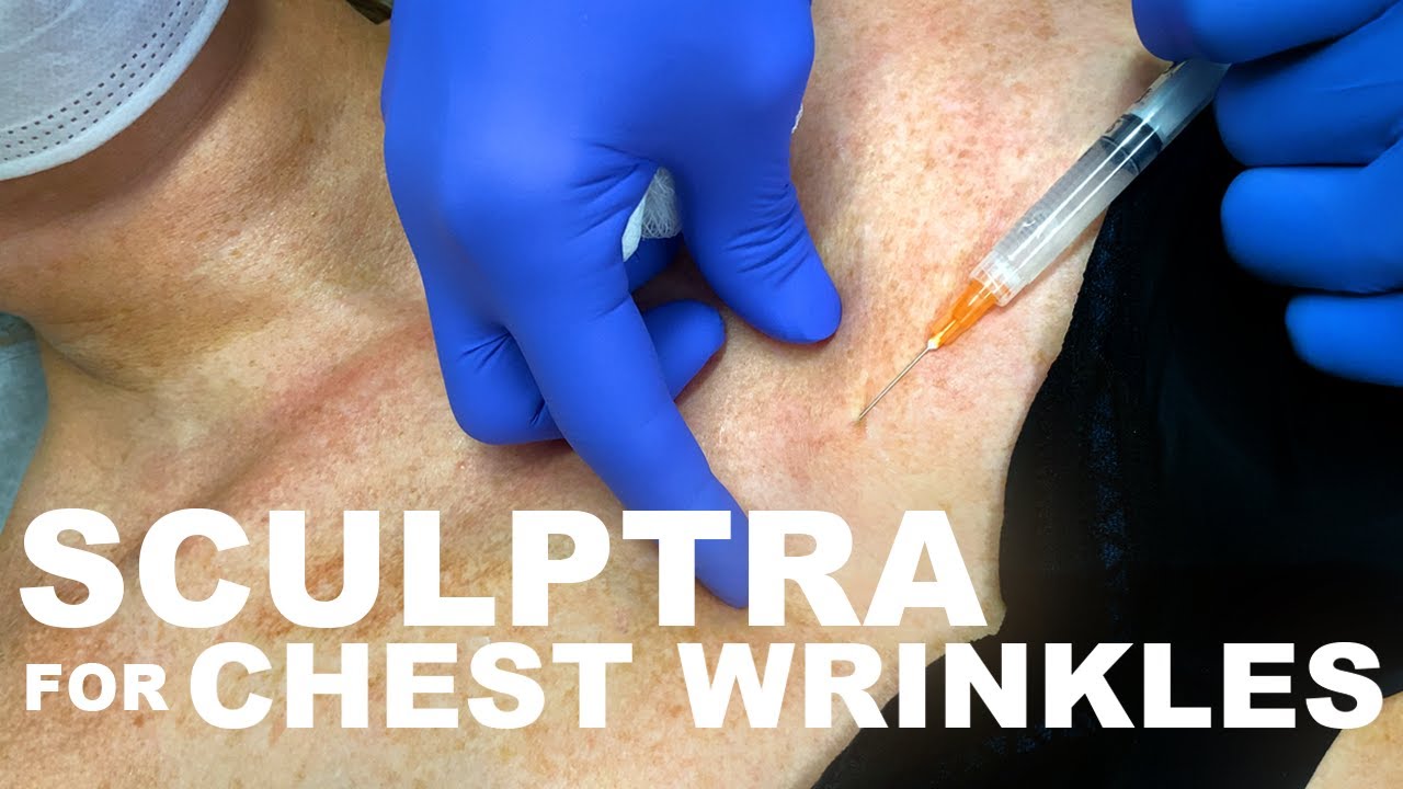 Injection treatment for chest wrinkles with Sculptra.