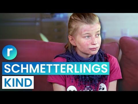 Meine Haut ist so empfindlich wie ein Schmetterlingsflügel | Teil 1