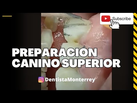 TALLADO  DENTAL 👅 Canino Superior