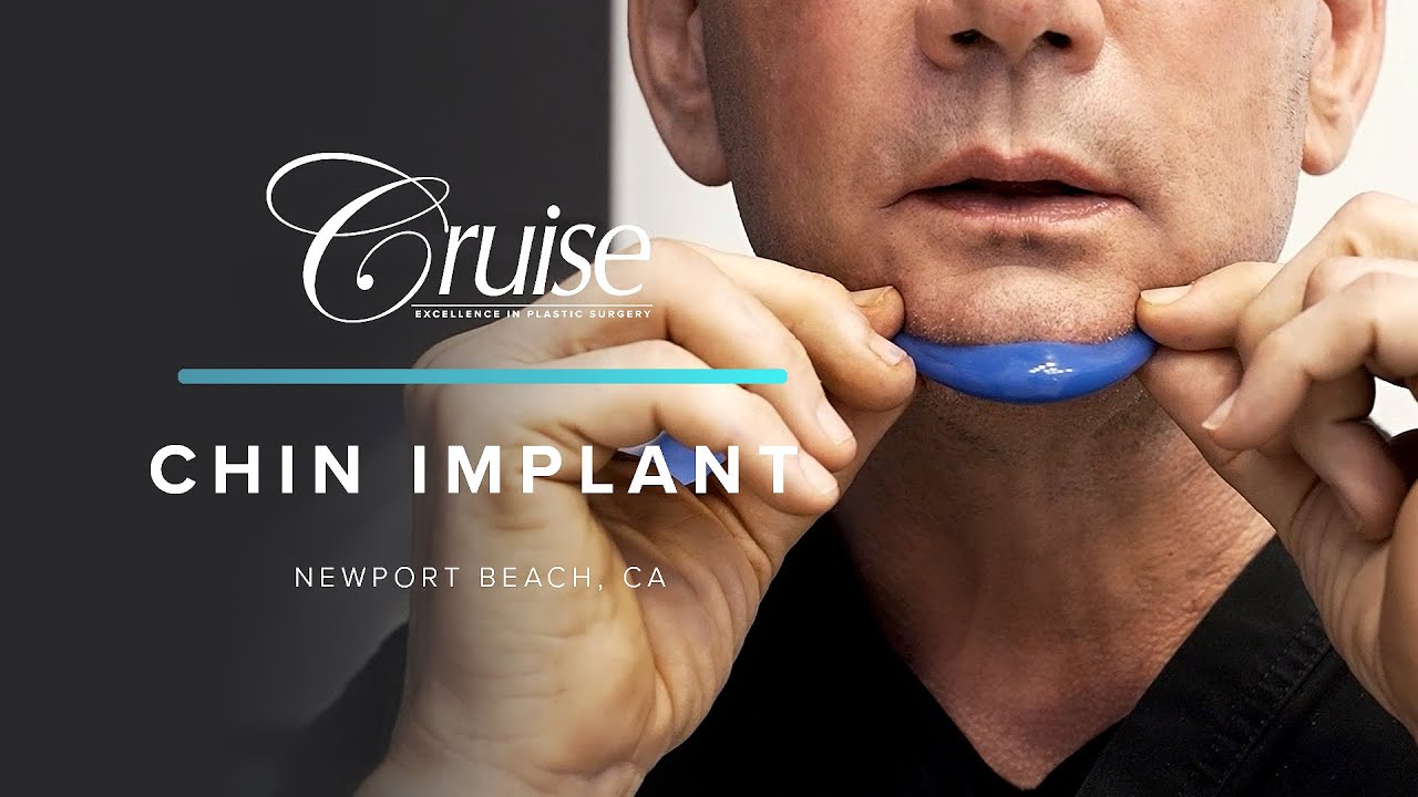 Demonstrating a chin implant procedure.