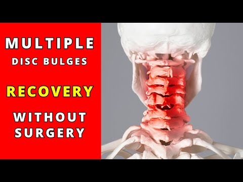 Cervical an lumbar  Disc Bulges recovery without surgery