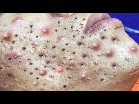 Big Cystic Acne Blackheads Extraction Blackheads & Milia, Whiteheads Removal Pimple Popping # 3918