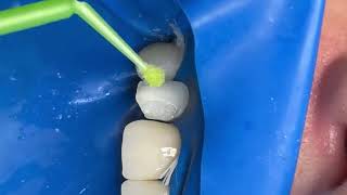 The dentist looks at the problem area and does it carefully #dentist