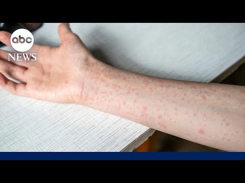 YouTube video thumbnail: South Carolina Measles Outbreak Doubles Within a Week