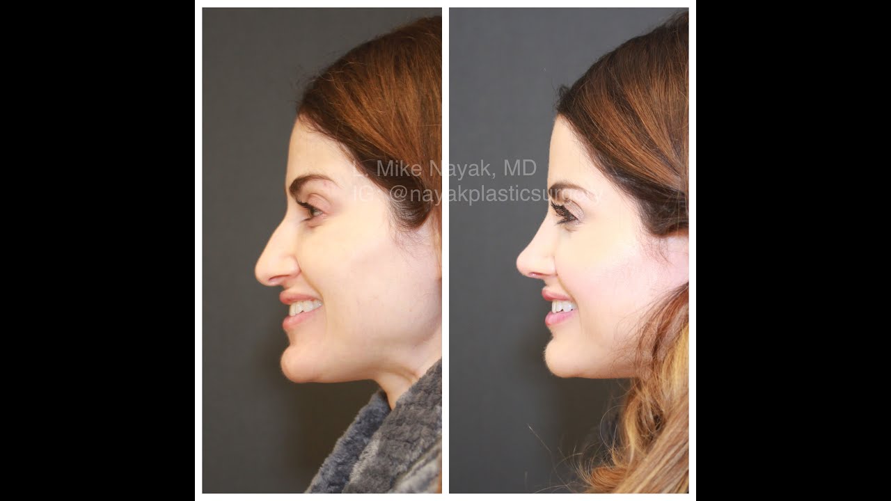 Before and after profile shots of a woman.