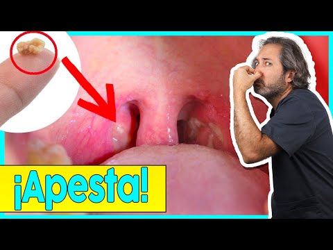 🚫¡EVITA los 𝗧𝗢𝗡𝗦𝗜𝗟𝗢𝗟𝗜𝗧𝗢𝗦! Como quitar esas 𝗔𝗣𝗘𝗦𝗧𝗢𝗦𝗔𝗦 BOLITAS BLANCAS en la garganta (🤮 MAL ALIENTO)