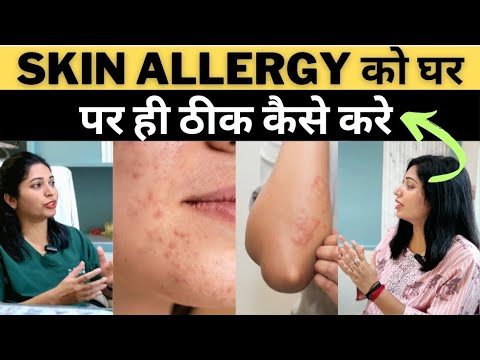 Skin Allergy ke Gharelu Upaay || स्किन एलर्जी के घरेलु इलाज || Home Remedies For Skin Allergy ||
