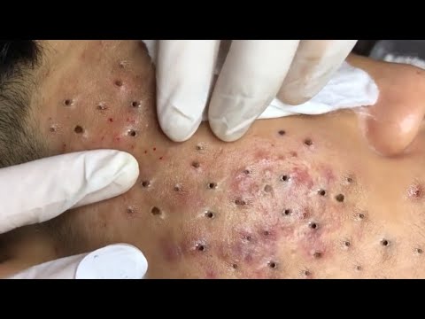 Big Cystic Acne Blackheads Extraction Blackheads & Milia, Whiteheads Removal Pimple Popping # 430