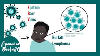 Burkitt Lymphoma and Epstein-Barr Virus Infection: Pathology and Diagnosis?