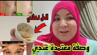 2مكونات فقط 💁‍♀️وصفة خطيرة للتخلص من تصبغات البشرة والبقع الداكنة وتهنيك من تجاعيد 👌