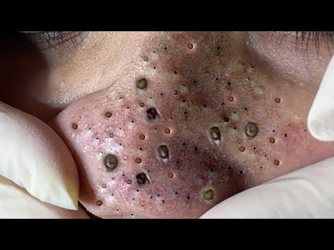 Big Cystic Acne Blackheads Extraction Blackheads & Milia, Whiteheads Removal Pimple Popping # 8707