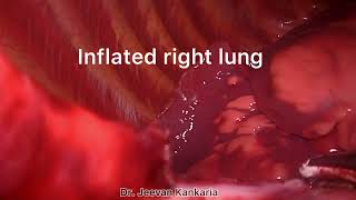 Laparoscopic Surgery for Congenital Diaphragmatic Hernia - Dr Jeevan Kankaria
