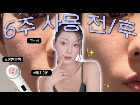 특히! 팔자 라인! 이런 드라마틱한 변화는 처음..☆  후기 위주로 자세히 풀어봄🔥 (ft. 울트라튠 역대 최저가 / 바디샷 공짜..)