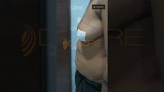 Double Incision FTM TOP surgery result