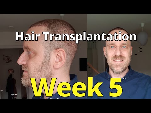 Hair Transplantation Week 5 (with Elithair / ENGLISH)