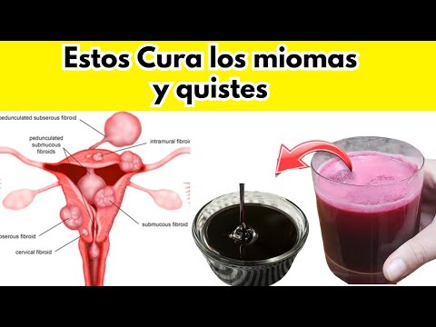 CURA LOS MIOMAS Y QUISTES /SECRETO DE LA REMOLACHA