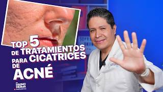 TOP 5 DE TRATAMIENTOS PARA CICATRICES DE ACNÉ