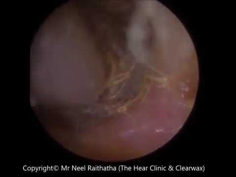 scleral patch graft cpt code