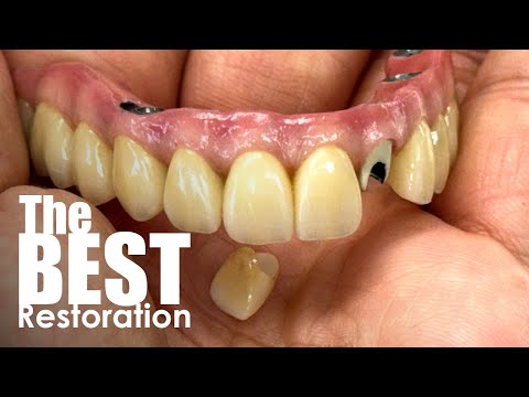 This Is How Dental Patient's Get The Very Best Full-Mouth Restoration