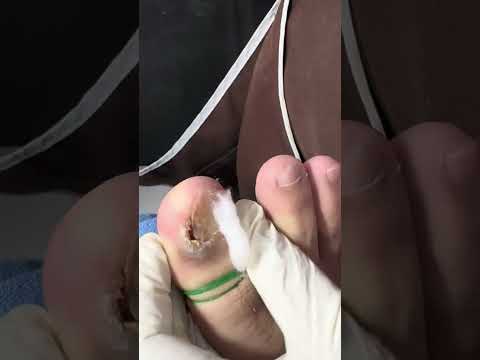 Ep_7838 Foot nails skin removal 👣 แข็งใจ..อีกข้างเดียว 😄 (clip from Thailand)