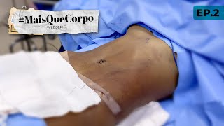 A CIRURGIA, FUI VISITAR A JU... - PARTE 2 #MAISQUECORPO
