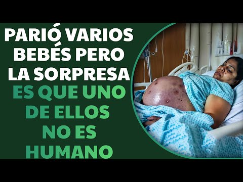 Mujer Tuvo 9 Bebés Pero Doctor Se Asusta Al Enterarse Que Uno De Ellos NO ES HUMANO