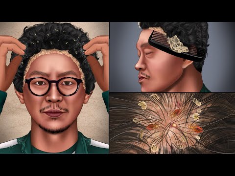 ASMR 근질근질 '오징어 게임' 용식이의 머릿니 시원~하게 제거하기ㅣ지루성 두피 치료ㅣ Get rid of tons of head lice2