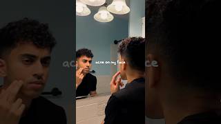 My Acne Journey