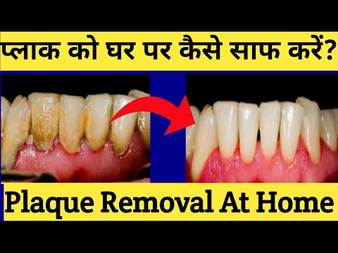 प्लाक को घर पर ही कैसे साफ करें? |How To Remove Plaque At Home |plaque Ko Ghar Pe Kaise Hataye