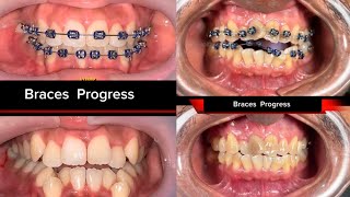 BRACES BEFORE & AFTER  , Just watch it